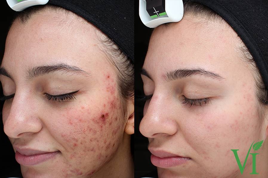 Clear Acne Or Hyperpigmentation With A Vi Peel With Precision Plus 350 By Magdalen S Pure Skin Care In Rockville Md Alignable