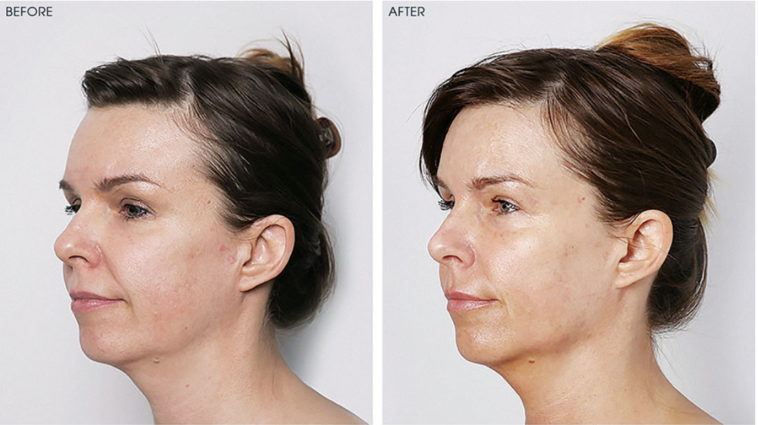 Zaffiro Thermolifting 2 in 1 Skin Rejuvenation by SkinMD Seattle Laser