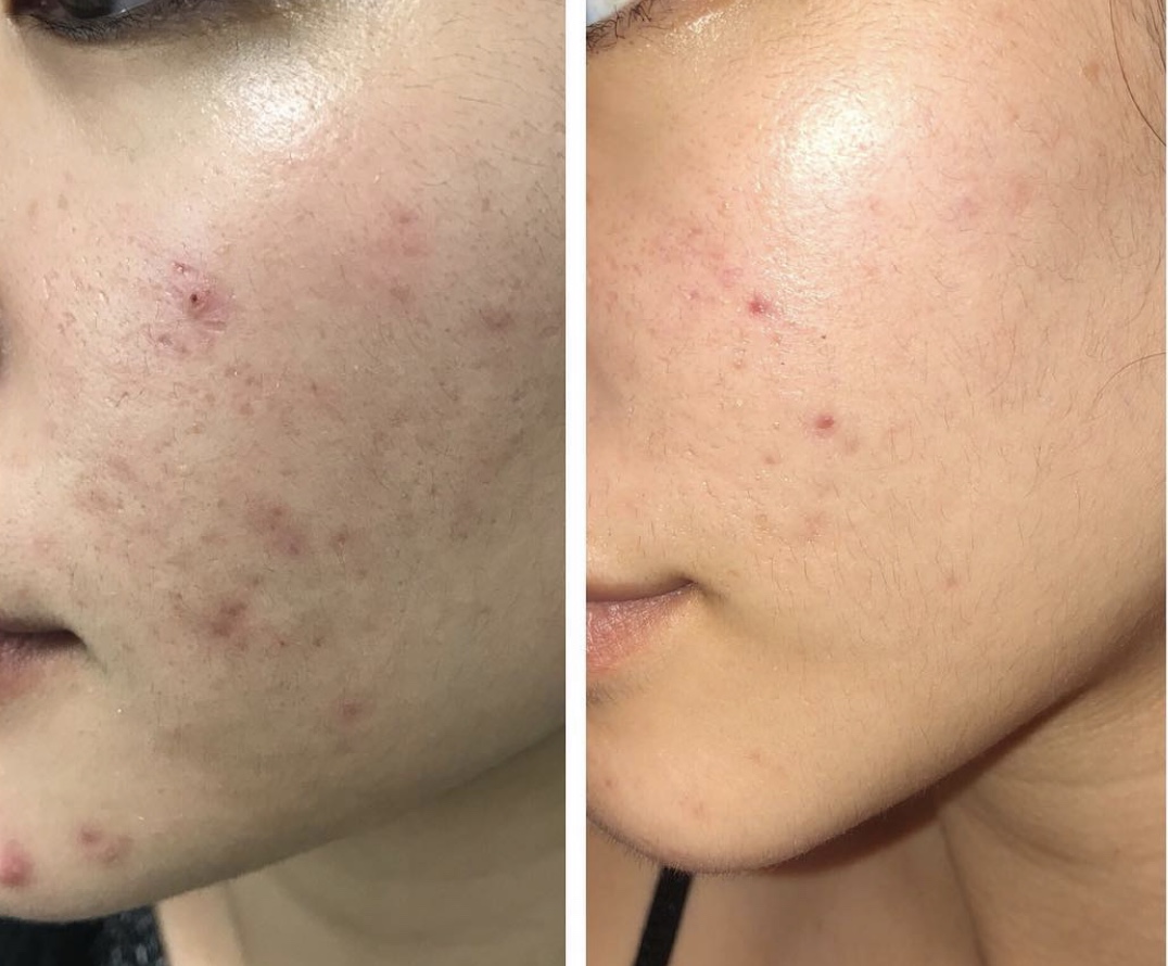 Acne Scarring Correction Dallas, Skin Rejuvenation Plano, TX
